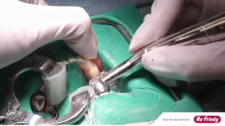 Hu-Friedy's Stainless Steel Pedo Crowns: From the Operatory to Presenting Treatment Options